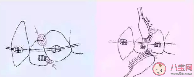 正畸戴牙套用什么清潔牙齒 ?戴牙套清潔牙齒要注意什么 正畸戴牙套用什么清潔牙齒 ?戴牙套清潔牙齒要注意什么