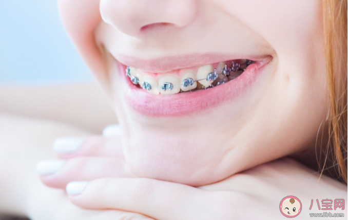 正畸戴牙套用什么清潔牙齒 ?戴牙套清潔牙齒要注意什么 正畸戴牙套用什么清潔牙齒 ?戴牙套清潔牙齒要注意什么
