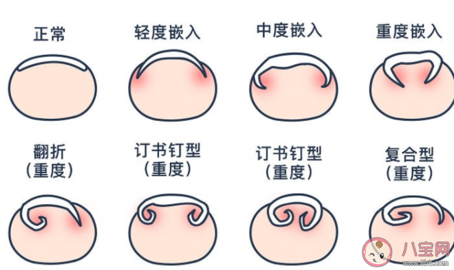 指甲太短容易得甲溝炎嗎 甲溝炎有什么辦法好轉