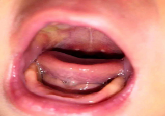 皰疹性咽峽炎幾歲孩子最常見 皰疹性咽峽炎怎么對癥護理