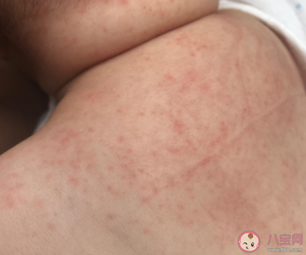 孩子洗澡水里滴去痱水有用嗎 夏天怎么預(yù)防寶寶起痱子 孩子洗澡水里滴去痱水有用嗎 夏天怎么預(yù)防寶寶起痱子