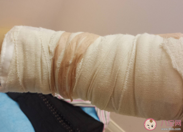 抽脂手術(shù)有什么風(fēng)險 壞死性筋膜炎有多危險