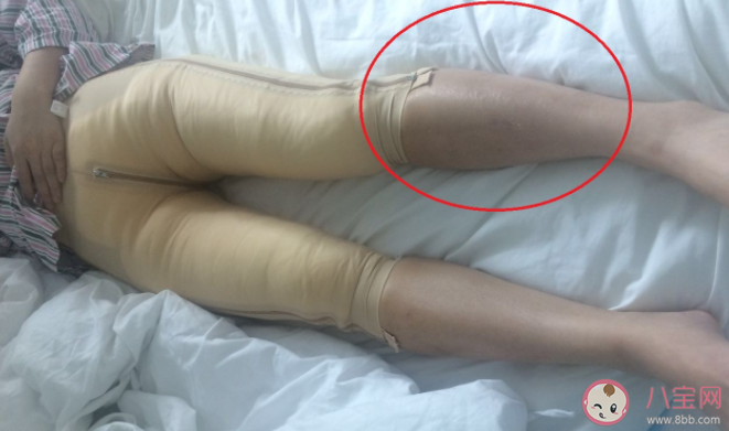 抽脂手術(shù)有什么風(fēng)險 壞死性筋膜炎有多危險