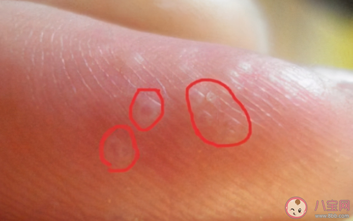 一到夏天就長(zhǎng)的小水泡是什么 患上汗皰疹怎么辦