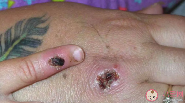 美國近20年來出現首例猴痘病毒病例 猴痘病毒有什么癥狀表現