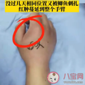 女子被魚刺扎破后渾身長滿疙瘩 被魚刺扎了會怎么樣