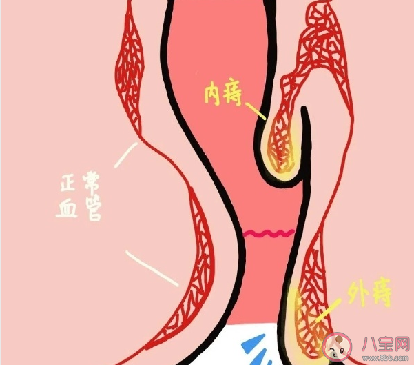 痔瘡疼痛出血怎么辦 痔瘡什么時(shí)候必須手術(shù)