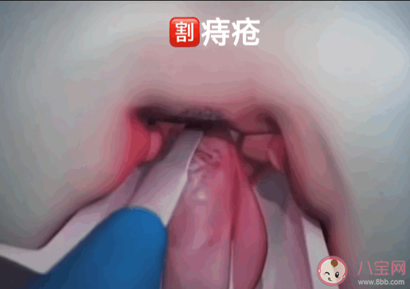 痔瘡疼痛出血怎么辦 痔瘡什么時(shí)候必須手術(shù)