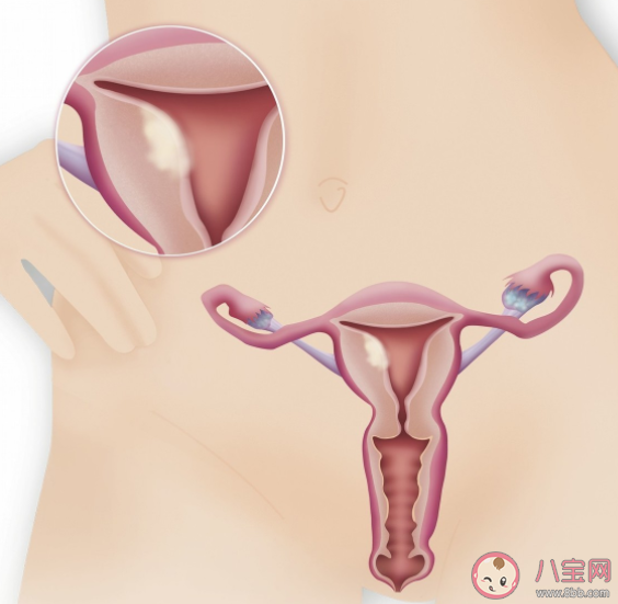 孕婦子宮肌瘤可以在剖宮產時一起拿掉嗎 孕期子宮肌瘤是保守觀察還是治療 孕婦子宮肌瘤可以在剖宮產時一起拿掉嗎 孕期子宮肌瘤是保守觀察還是治療