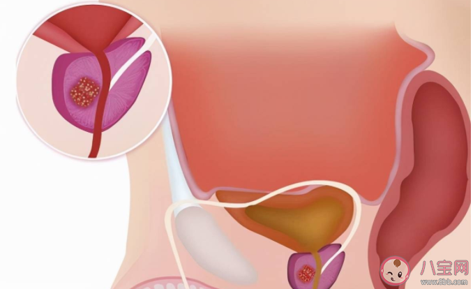 男性排尿困難是前列腺發炎嗎 男性日常如何保持前列腺健康 男性排尿困難是前列腺發炎嗎 男性日常如何保持前列腺健康