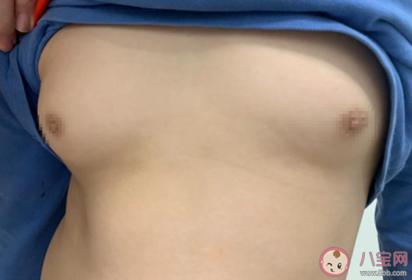 11歲男孩乳房發(fā)育直徑超4厘米是怎么回事 男性乳房發(fā)育正常嗎 11歲男孩乳房發(fā)育直徑超4厘米是怎么回事 男性乳房發(fā)育正常嗎