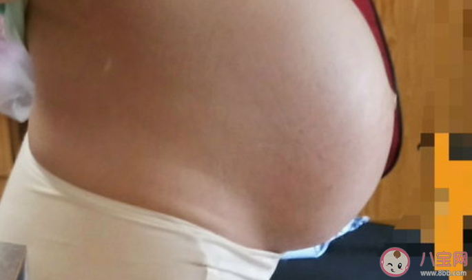 懸浮肚為什么不建議順產 懸浮肚有什么風險