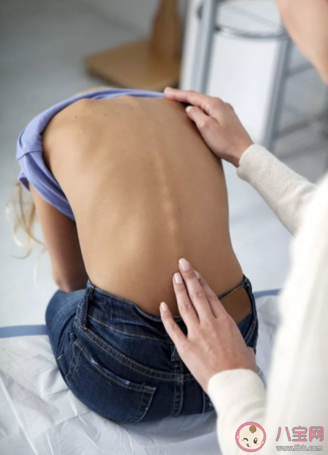 脊柱側彎最佳手術年齡是幾歲 如何糾正脊柱側彎 脊柱側彎最佳手術年齡是幾歲 如何糾正脊柱側彎