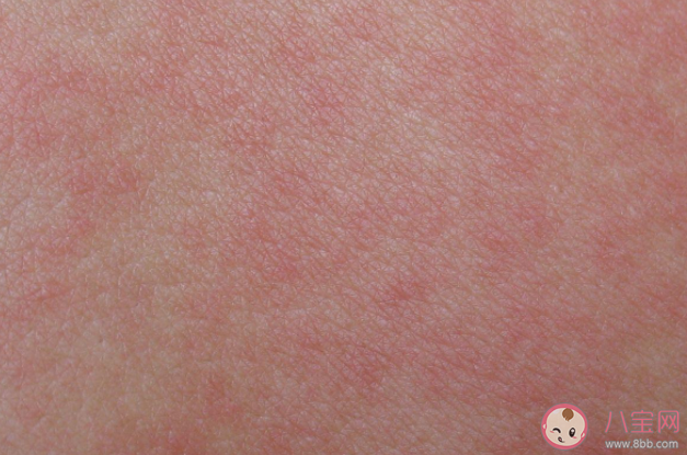 風疹是通過什么傳染的 孩子患了風疹怎么辦