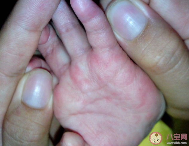 風疹是通過什么傳染的 孩子患了風疹怎么辦