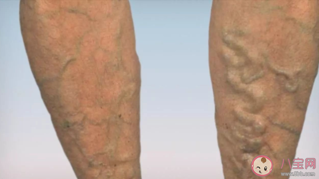 如何預(yù)防下肢靜脈曲張 下肢靜脈曲張不治療會怎樣