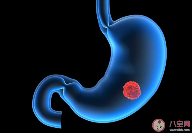 哪些是胃癌高危因素 感染幽門螺桿菌就一定會引起胃癌嗎