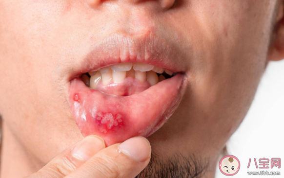 危險的口腔潰瘍長什么樣 口腔潰瘍的常見并發癥有哪些