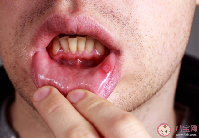 危險的口腔潰瘍長什么樣 口腔潰瘍的常見并發癥有哪些