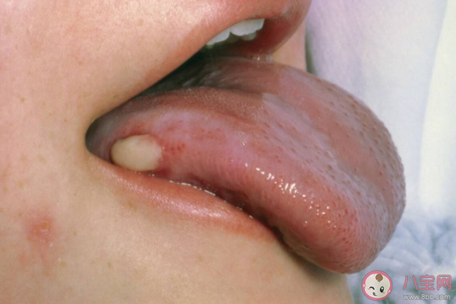 危險的口腔潰瘍長什么樣 口腔潰瘍的常見并發癥有哪些