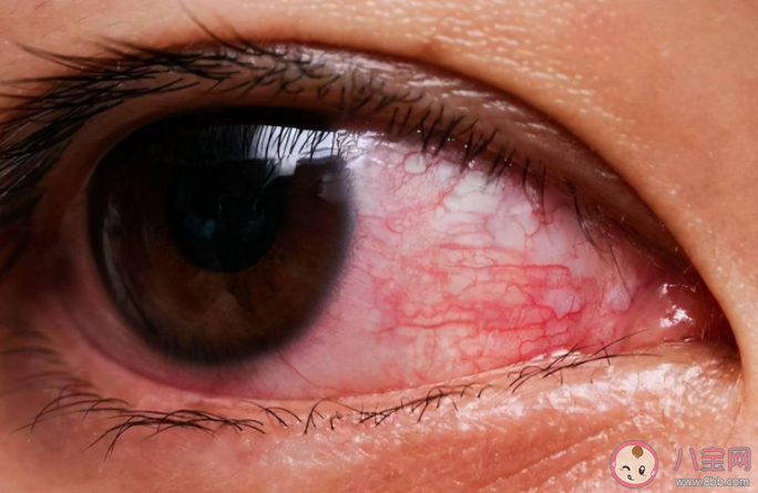 過敏性結膜炎忍一忍就好了嗎 過敏性結膜炎如何防護 過敏性結膜炎忍一忍就好了嗎 過敏性結膜炎如何防護