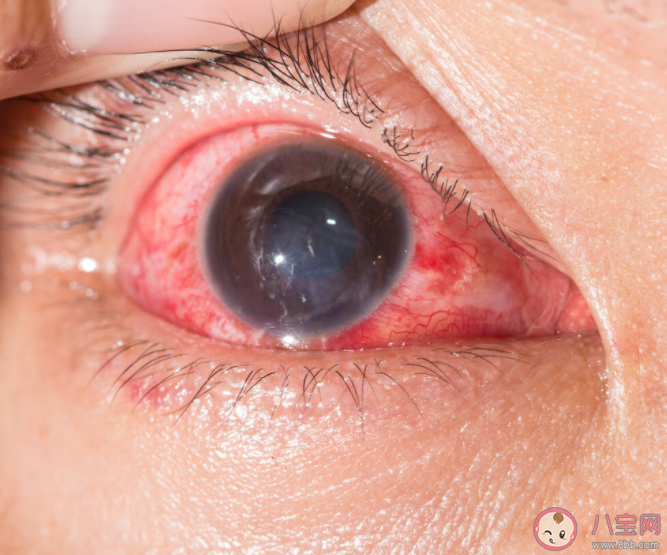 過敏性結膜炎忍一忍就好了嗎 過敏性結膜炎如何防護 過敏性結膜炎忍一忍就好了嗎 過敏性結膜炎如何防護