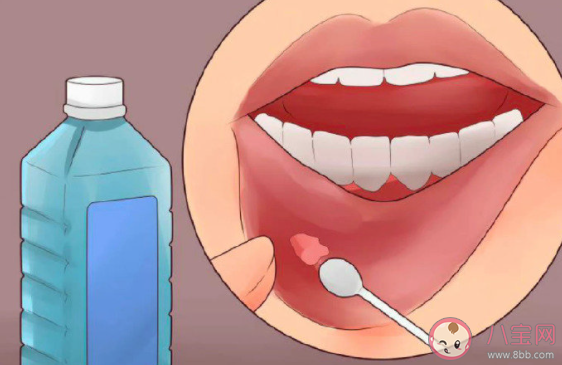 如何快速緩解口腔潰瘍 嘴巴口腔潰瘍了該怎么辦