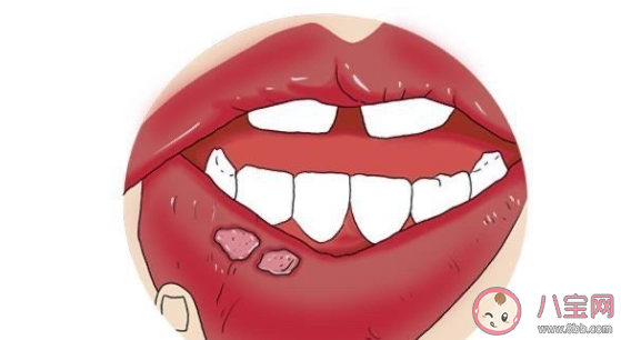如何快速緩解口腔潰瘍 嘴巴口腔潰瘍了該怎么辦