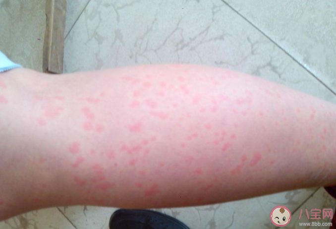 蕁麻疹可以治好不復發嗎 蕁麻疹的病因有哪些 蕁麻疹可以治好不復發嗎 蕁麻疹的病因有哪些