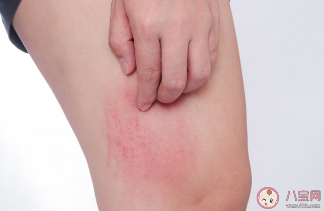 蕁麻疹可以治好不復發嗎 蕁麻疹的病因有哪些 蕁麻疹可以治好不復發嗎 蕁麻疹的病因有哪些