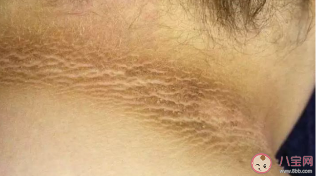 為何有些肥胖人士脖子老是洗不干凈 黑棘皮病嚴重嗎危害大不大