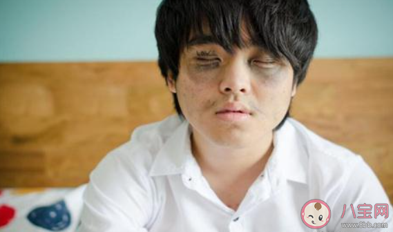 為什么不熬夜也會有黑眼圈 該如何消除黑眼圈