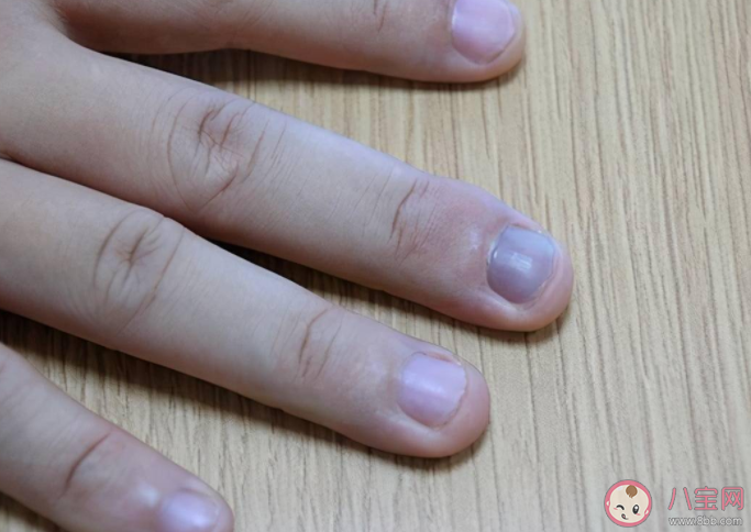 灰指甲可以不治嗎 灰指甲拔了才能徹底治好嗎