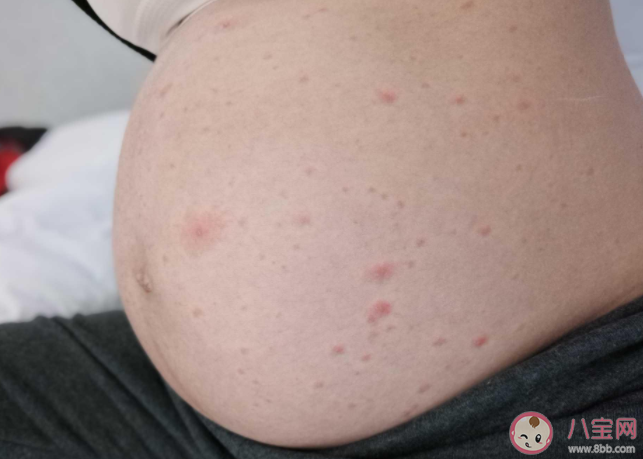 孕期長水痘對胎兒有什么影響 孕期水痘怎么處理 孕期長水痘對胎兒有什么影響 孕期水痘怎么處理