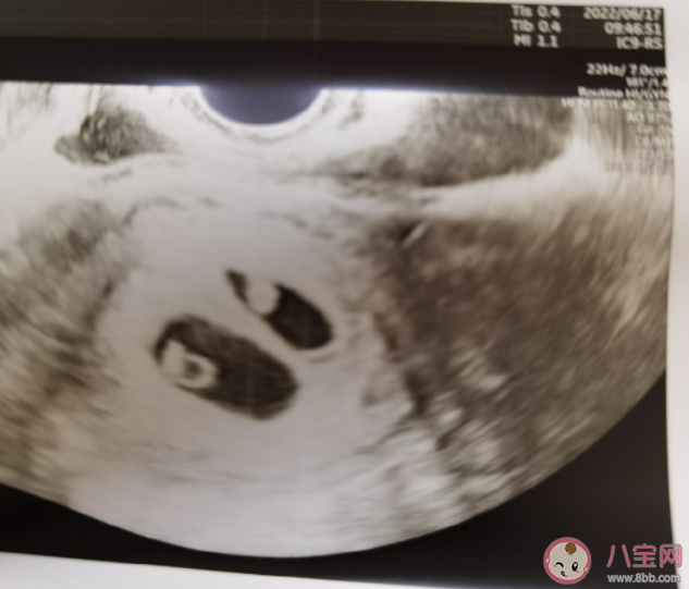 正常的胎心大概是多少 怎么做胎心監(jiān)護才能一次性過