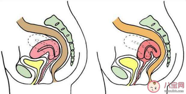 子宮前位更容易懷孕嗎 子宮前位的女性該如何保養身體