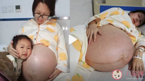 女子二胎懷3胞胎出行要靠輪椅是什么情況 懷了多胞胎需要注意什么