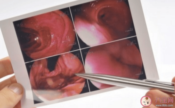 為什么做胃鏡還要查梅毒和艾滋病 胃腸鏡檢查的流程是怎樣的 為什么做胃鏡還要查梅毒和艾滋病 胃腸鏡檢查的流程是怎樣的