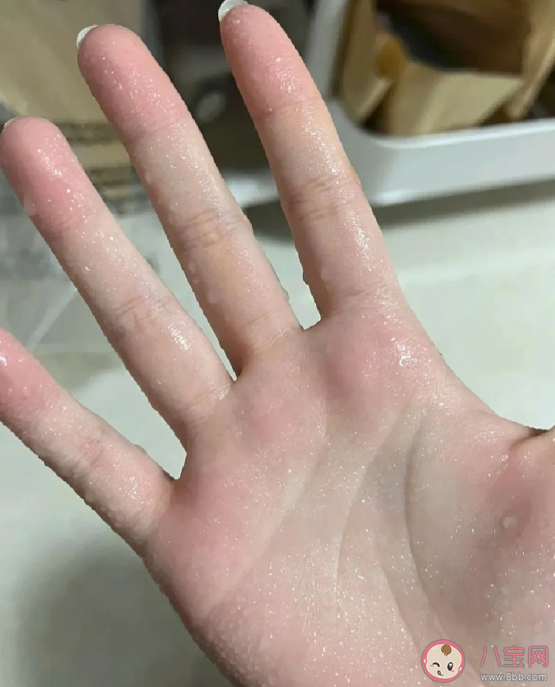 手汗癥為什么要去胸外科治療 手汗癥需要手術治療嗎