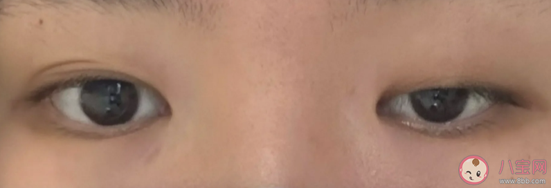 上瞼下垂能自愈嗎 上瞼下垂有哪些治療方法