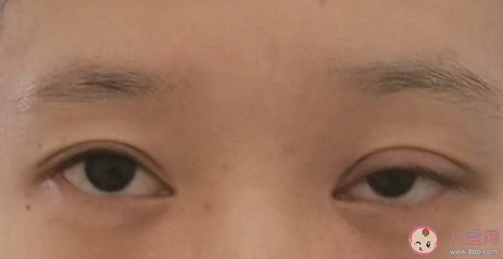 上瞼下垂能自愈嗎 上瞼下垂有哪些治療方法