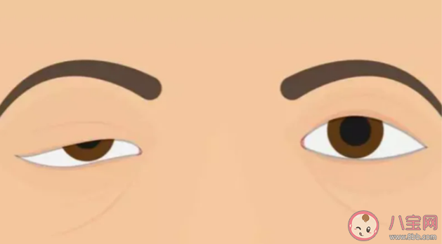 上瞼下垂能自愈嗎 上瞼下垂有哪些治療方法