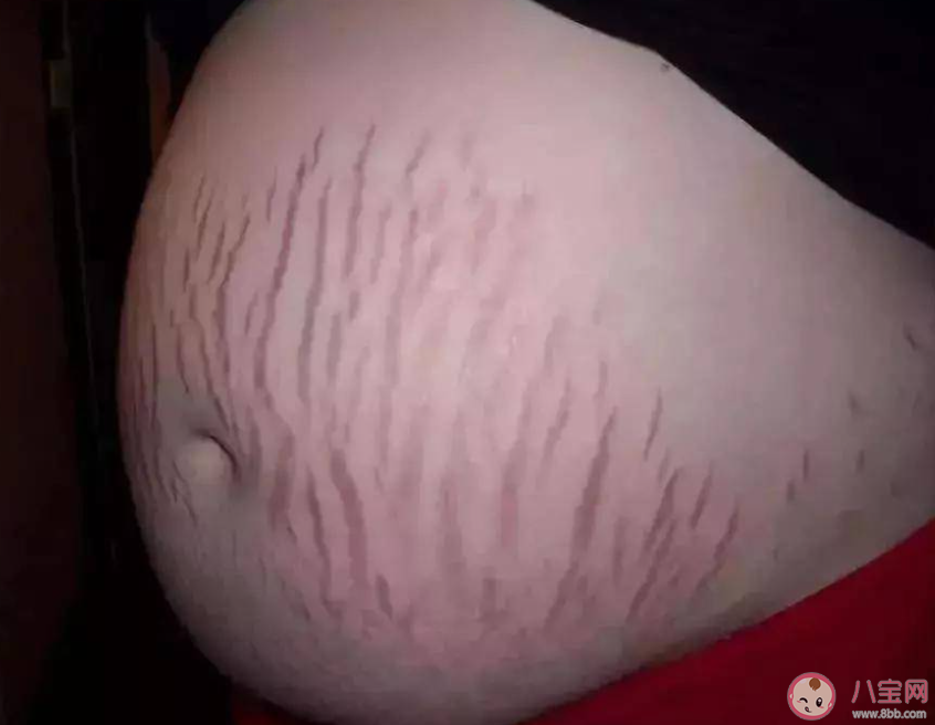 女子花2萬修復(fù)妊娠紋無效起訴退款 妊娠紋后期能被修復(fù)嗎