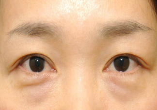 眼袋會(huì)遺傳嗎 如何科學(xué)改善眼袋