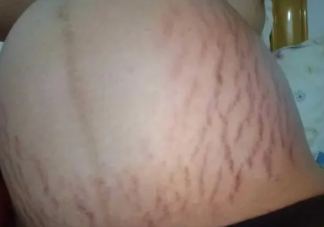 女子花2萬修復(fù)妊娠紋無效起訴退款 妊娠紋后期能被修復(fù)嗎