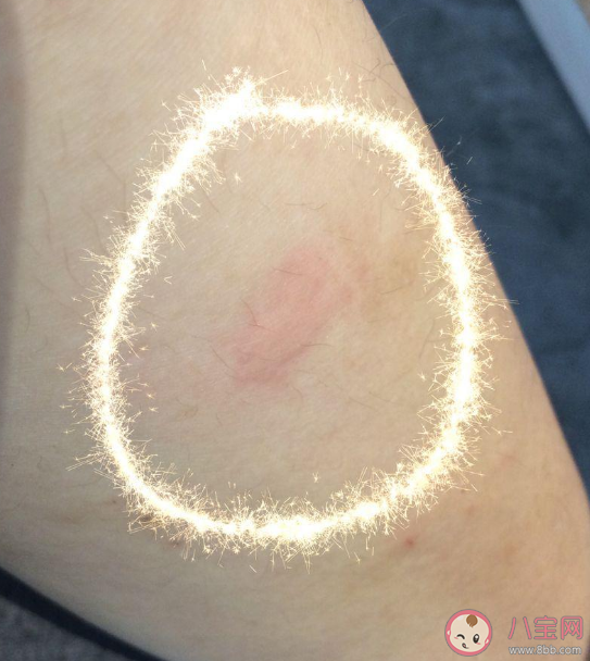 過敏原檢測是智商稅嗎 過敏原檢測要不要查