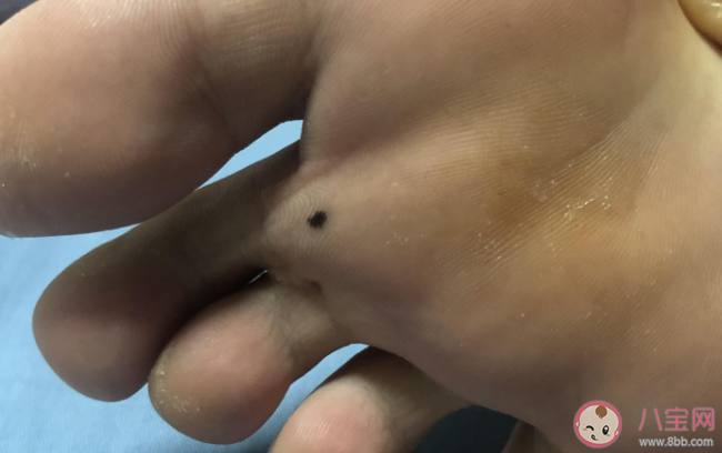 腳底長痣容易惡變嗎 4個做法會使黑痣癌變 腳底長痣容易惡變嗎 4個做法會使黑痣癌變