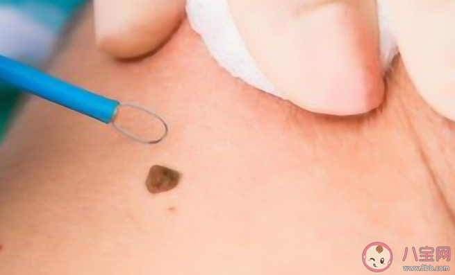 腳底長痣容易惡變嗎 4個做法會使黑痣癌變 腳底長痣容易惡變嗎 4個做法會使黑痣癌變