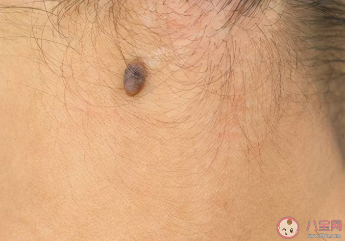 腳底長痣容易惡變嗎 4個做法會使黑痣癌變 腳底長痣容易惡變嗎 4個做法會使黑痣癌變