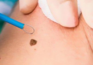 腳底長痣容易惡變嗎 4個做法會使黑痣癌變